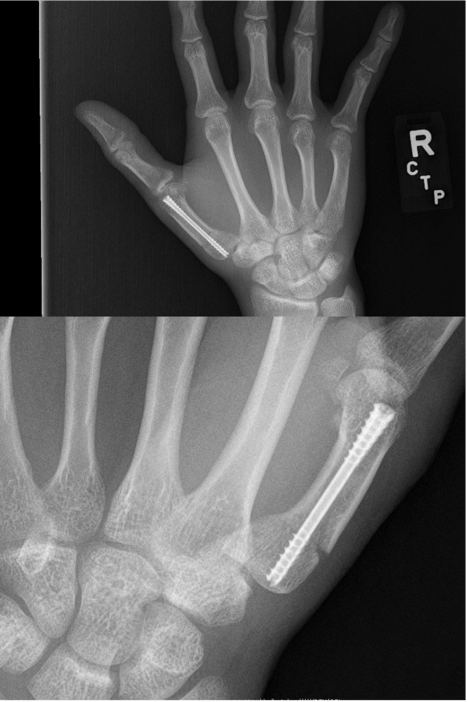 IntraOp