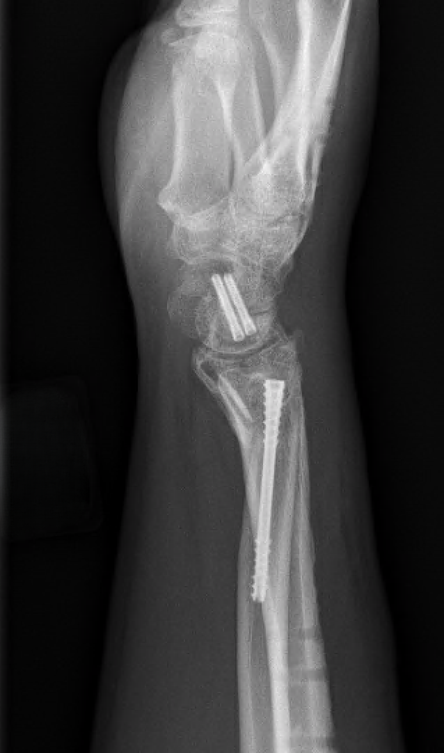 NX Nail fixation of distal ulna fracture in high energy wrist injury.