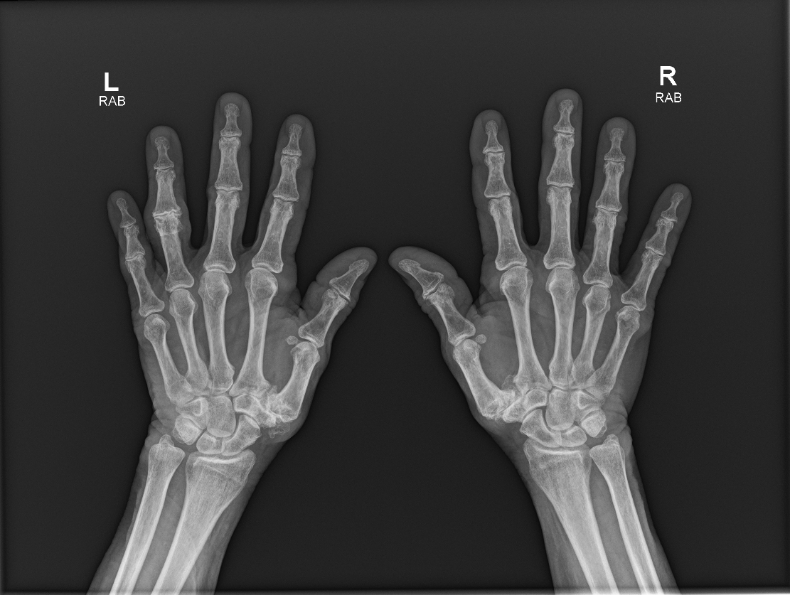 CR_XRAY RIGHT HAND_HAND PA_OBL_2024-01-25