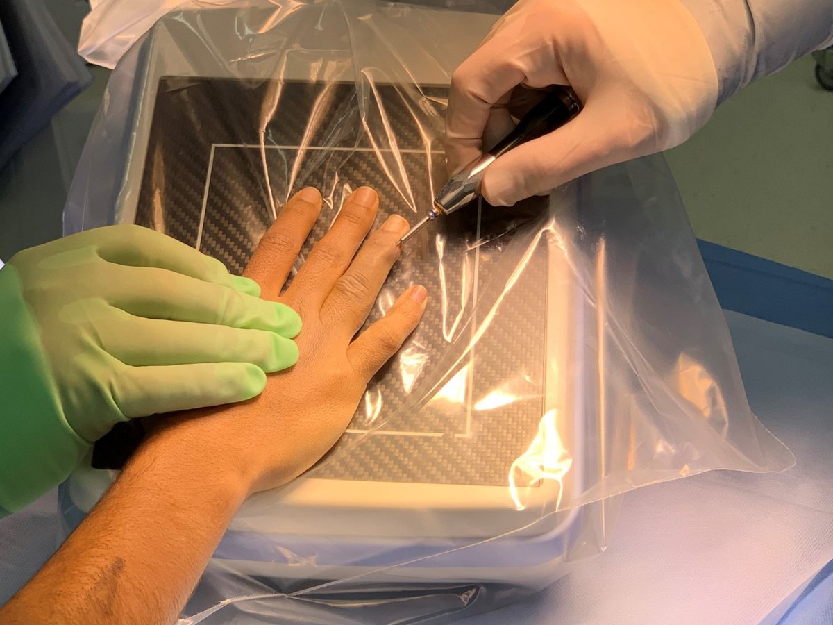 NX Nail for fixation of a comminuted middle P2 phalanx fracture.