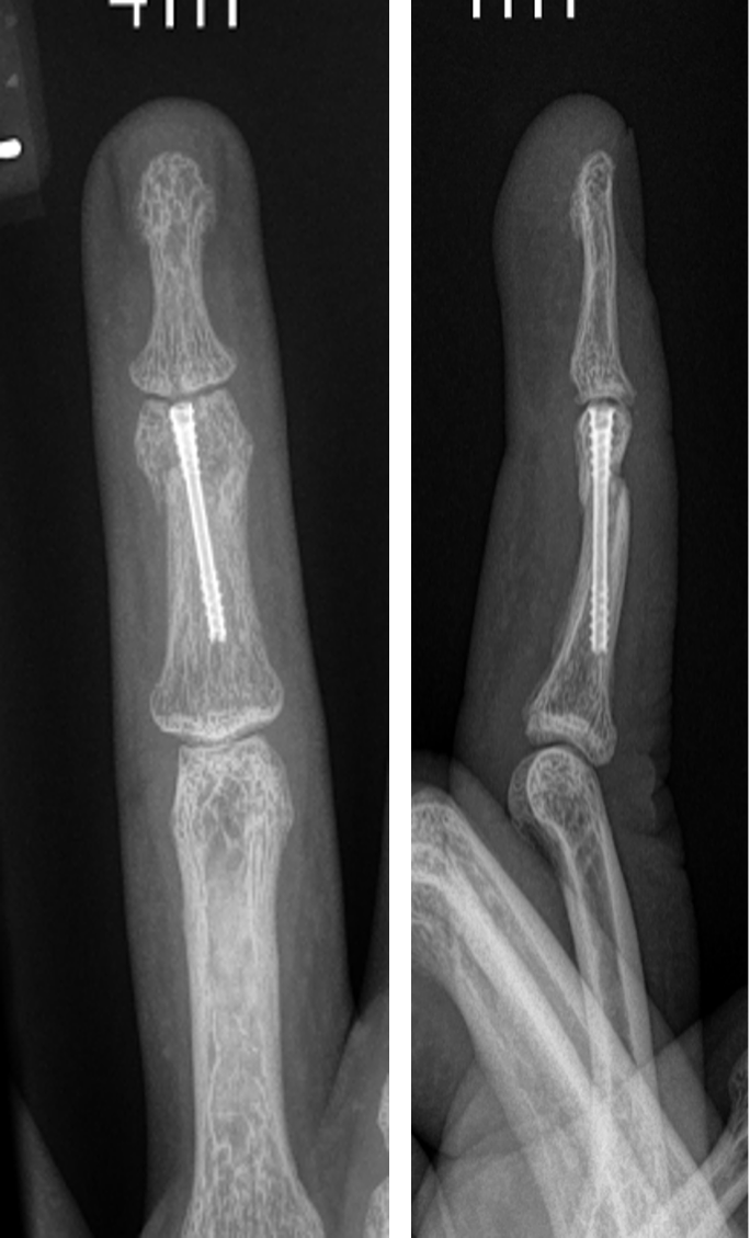 NX Nail fixation of a displaced head of P2 phalanx fracture.
