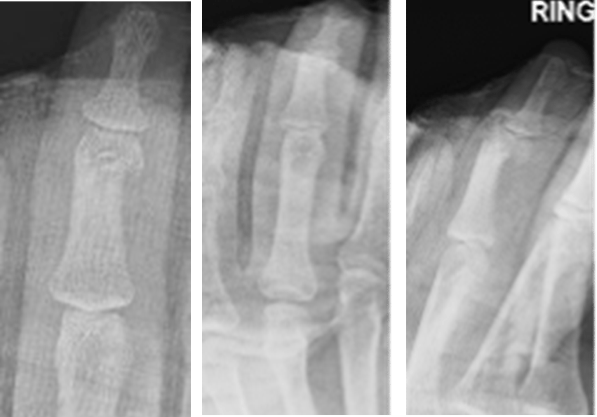 NX Nail fixation of a displaced head of P2 phalanx fracture.