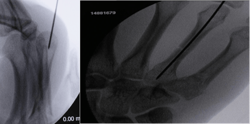 Kwire Radiograph