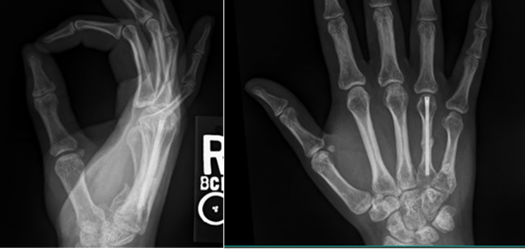 post operative radiograph