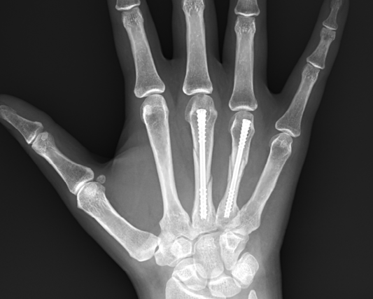 Post-op Xray of 3rd and 4th metacarpal fixation using Field Orthopaedics NX Nail