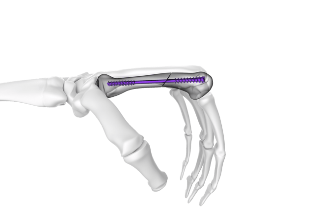 NX Nail_Implant in Situ_Surg Tech