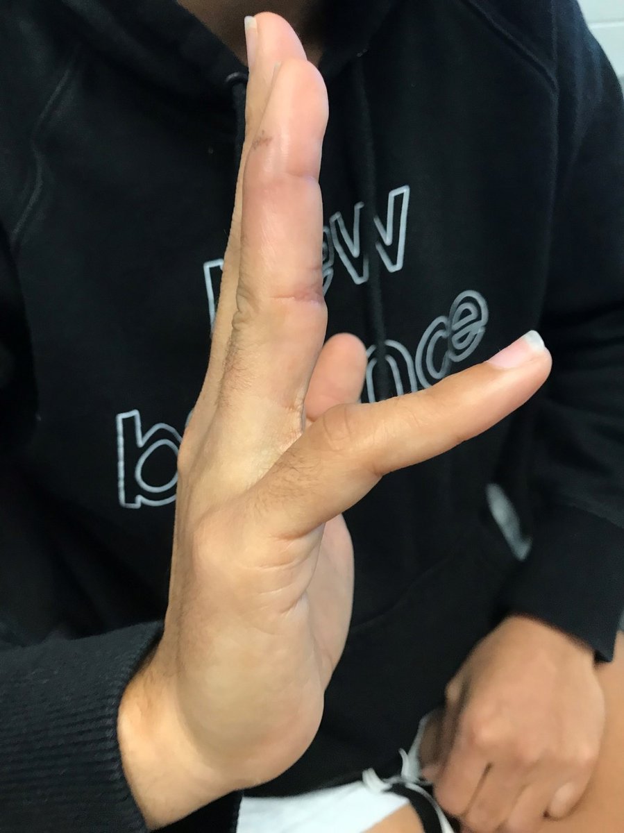 NX Nail for fixation of a comminuted middle P2 phalanx fracture.