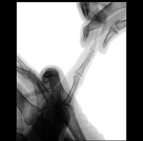 NX Nail for fixation of a comminuted middle P2 phalanx fracture.