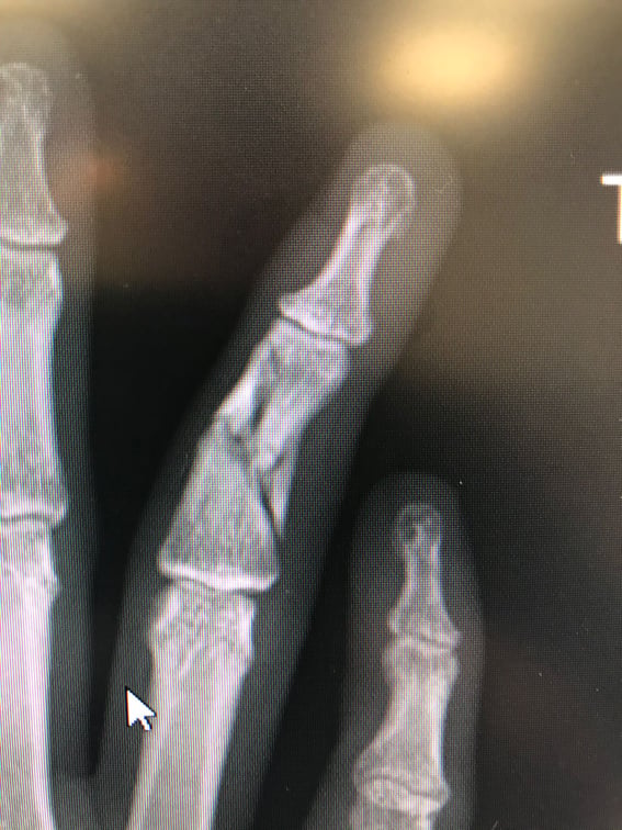 NX Nail for fixation of a comminuted middle P2 phalanx fracture.