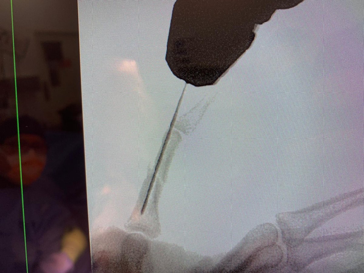 NX Nail for fixation of a comminuted middle P2 phalanx fracture.