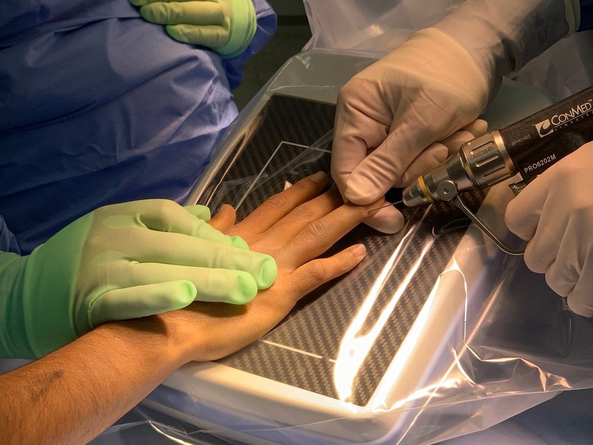 NX Nail for fixation of a comminuted middle P2 phalanx fracture.